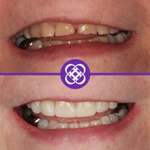 composite-bonding-before-after-1.jpg