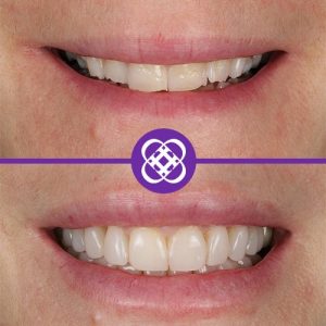 composite-bonding-before-after-3.jpg