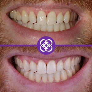 composite-bonding-before-after-5.jpg