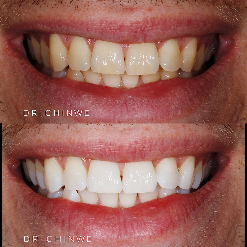 teeth-whitening-offer-example-1.jpg
