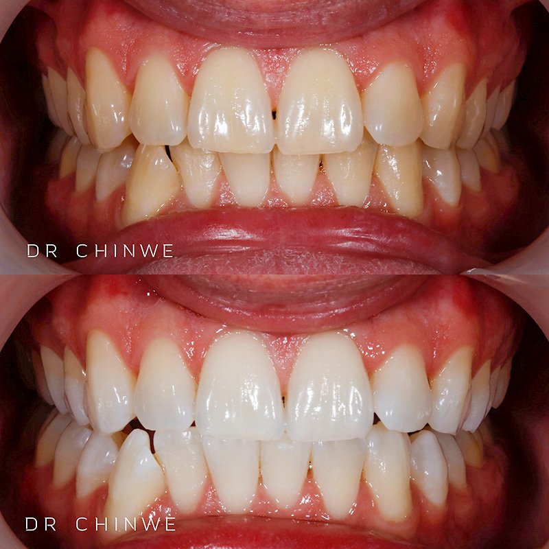 teeth-whitening-offer-example-2.jpg