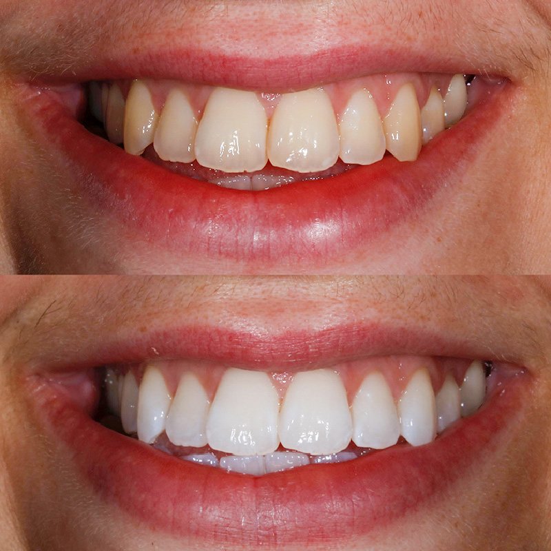 teeth-whitening-offer-example-3.jpg